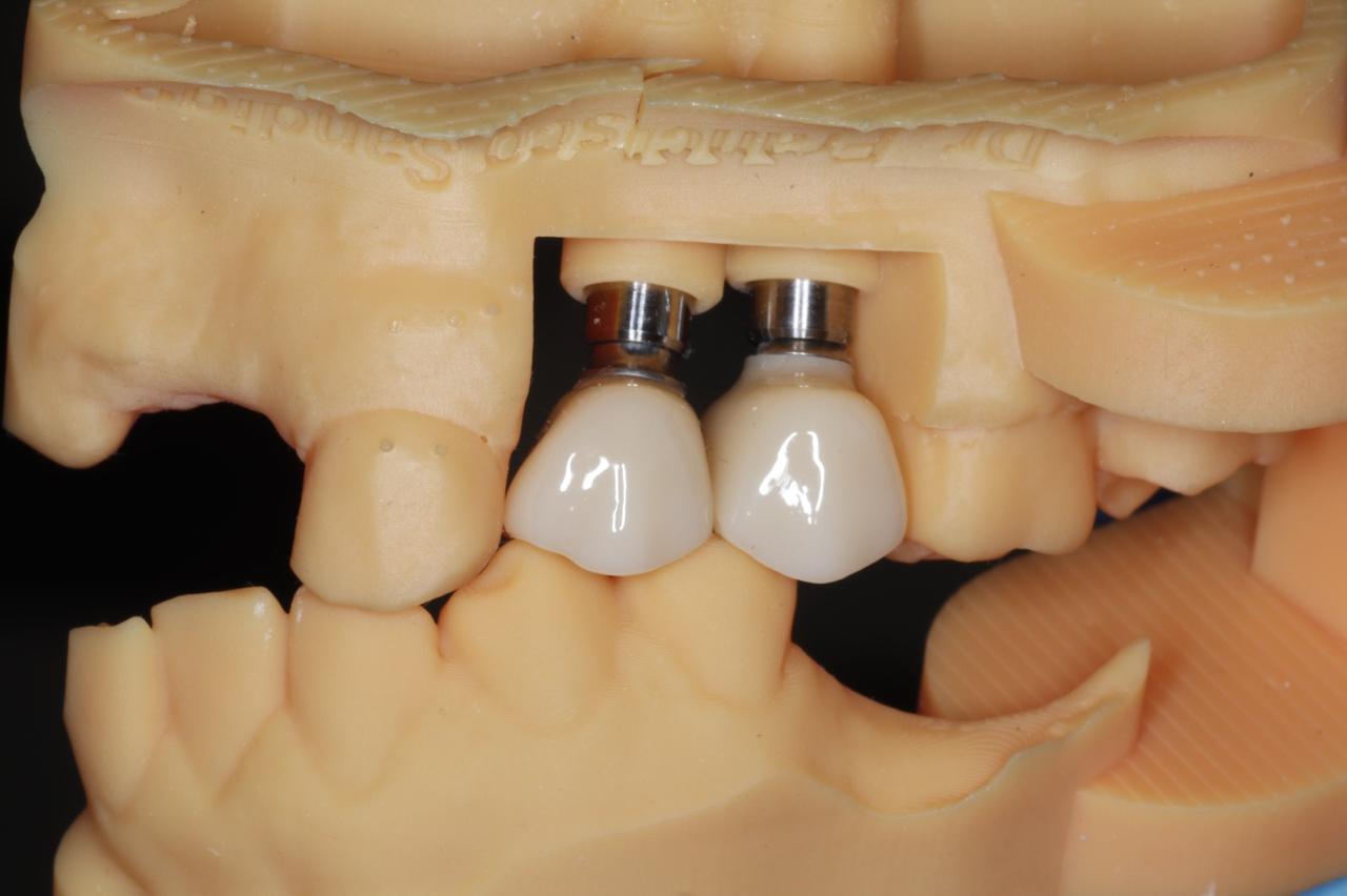 Implantes Dentales
